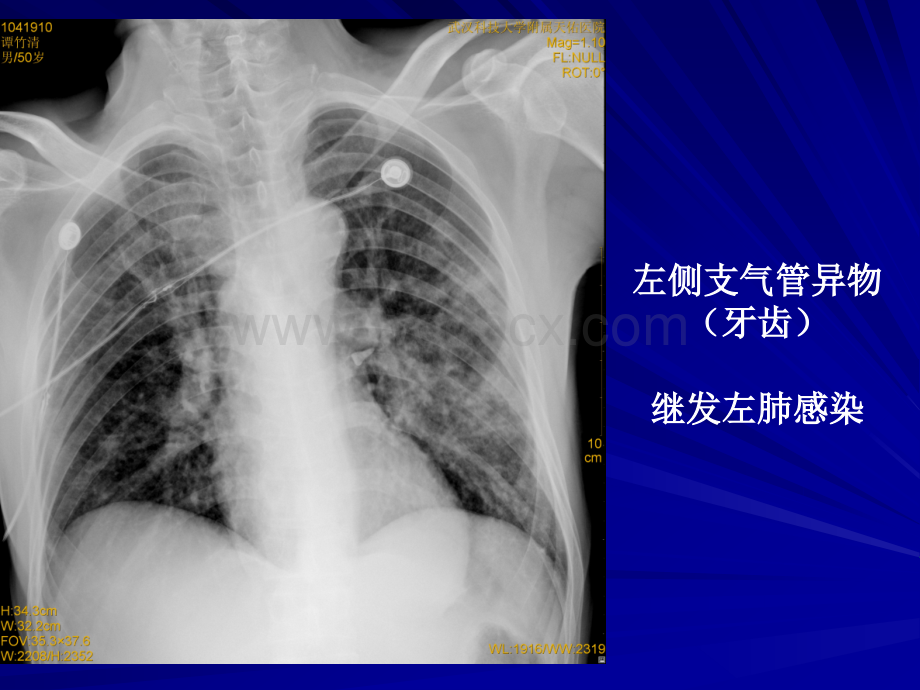 呼吸系统常见疾病影像诊断.ppt_第3页