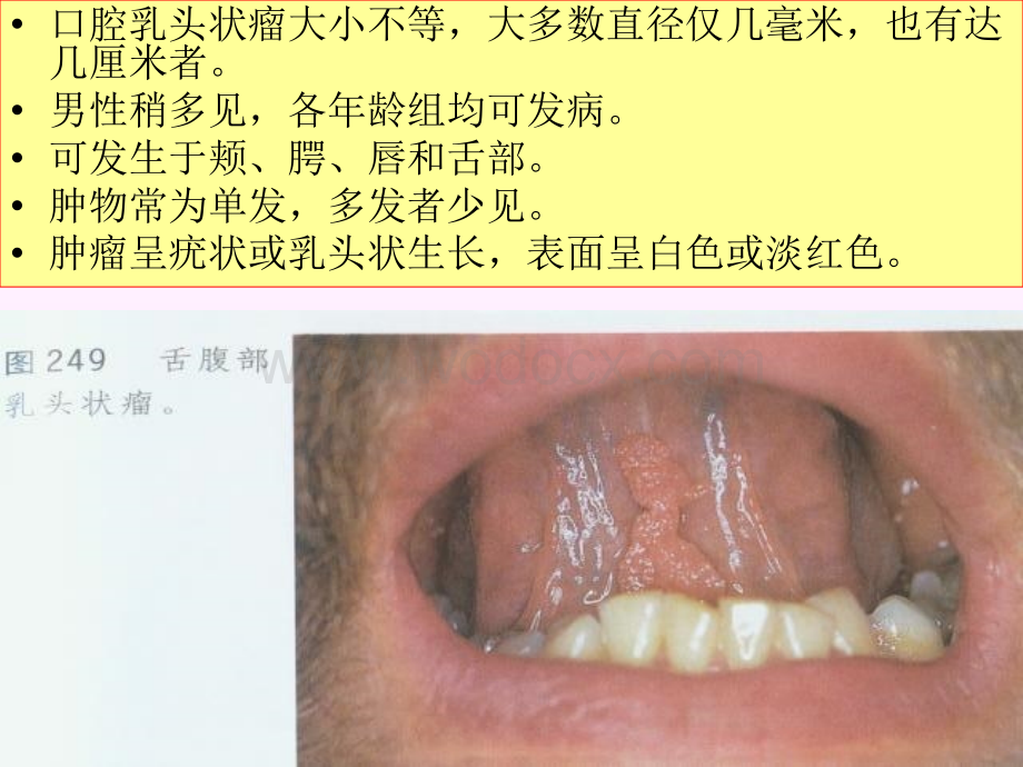 口腔颌面部其他组织来源的肿瘤.ppt_第3页