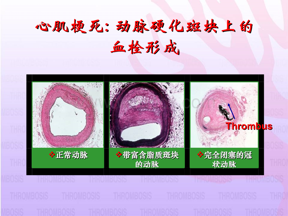 心肌梗死溶栓治疗.ppt_第3页