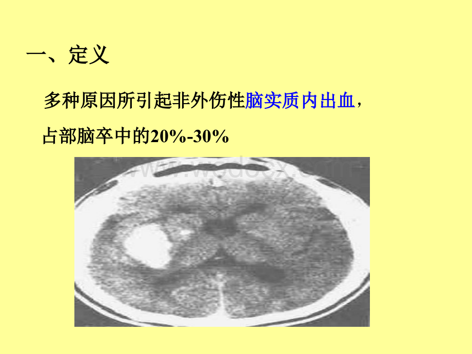 第七章脑出血课件.ppt_第2页