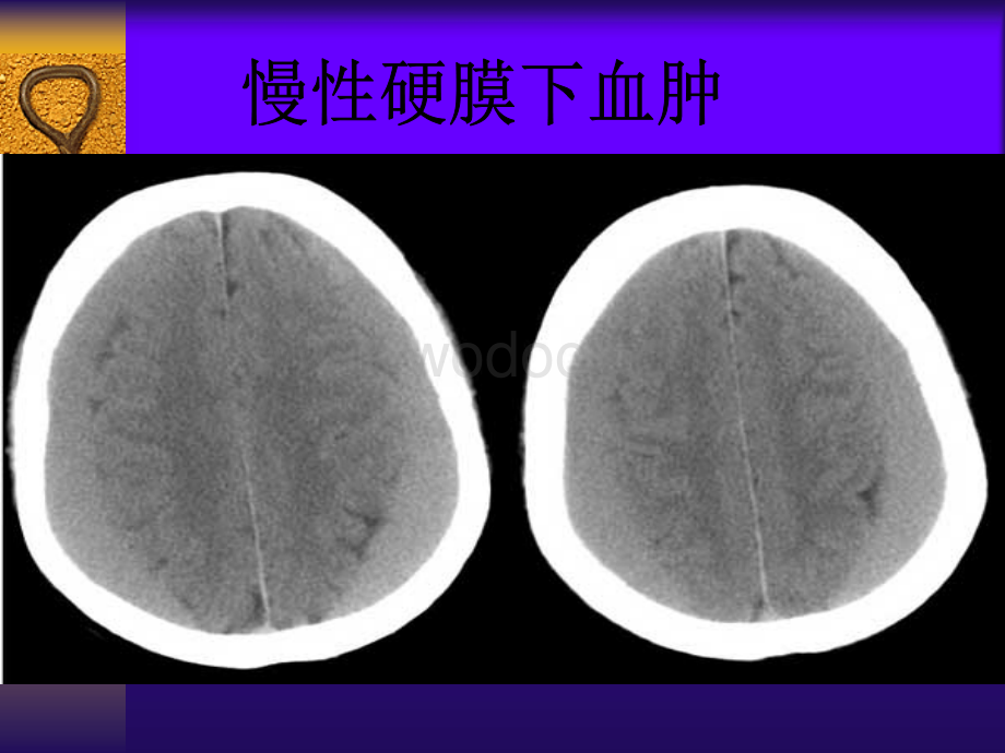 常见疾病CT诊断学.ppt_第3页